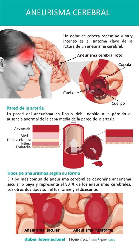 sintomas de aneurisma cerebral